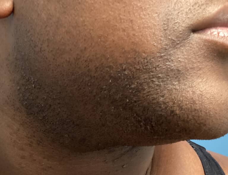 Before Image: Laser Hair Removal - right-front-oblique