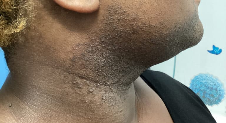 Before Image: Laser Hair Removal - right-back-oblique