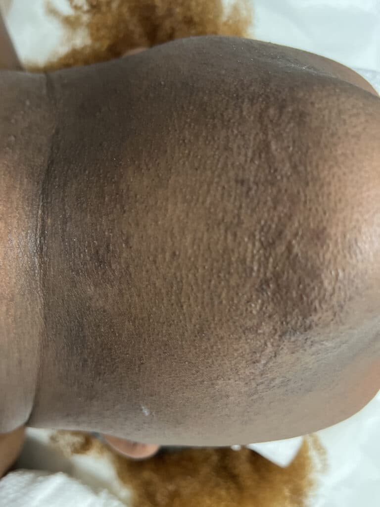 Before Image: Laser Hair Removal - other