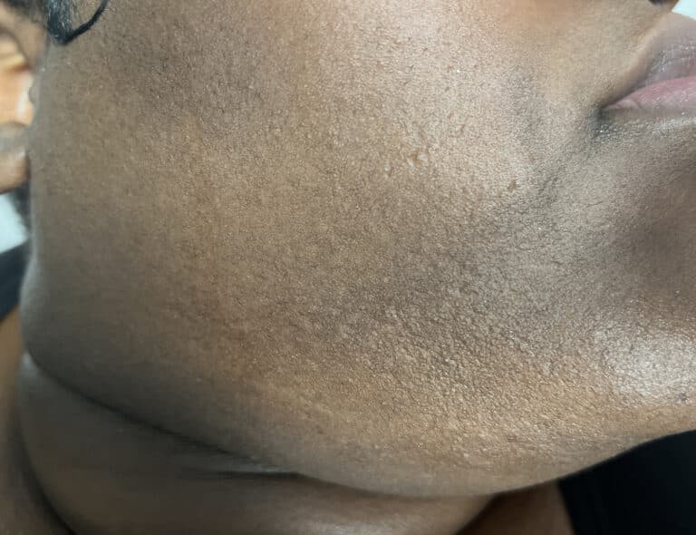 After Image: Laser Hair Removal - right-front-oblique