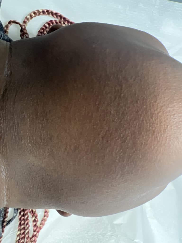 After Image: Laser Hair Removal - other