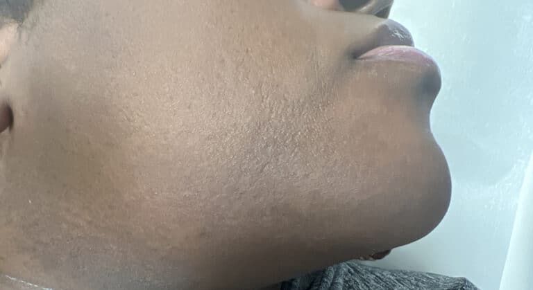 After Image: Laser Hair Removal - right-back-oblique