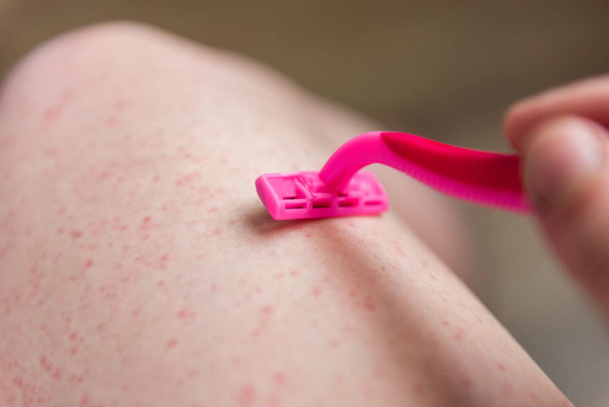 Closeup of legs with skin irritation after shaving, showing razor burn and redness.